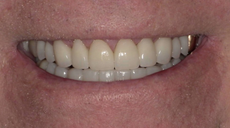 After treatment photo for Smile Gallery Case 18