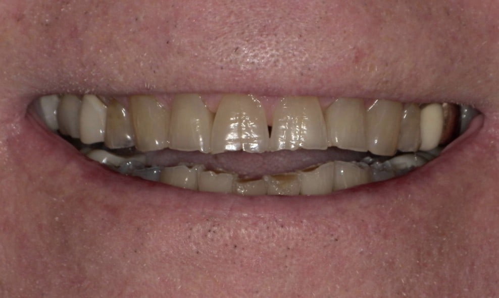 Before treatment photo for Smile Gallery Case 18
