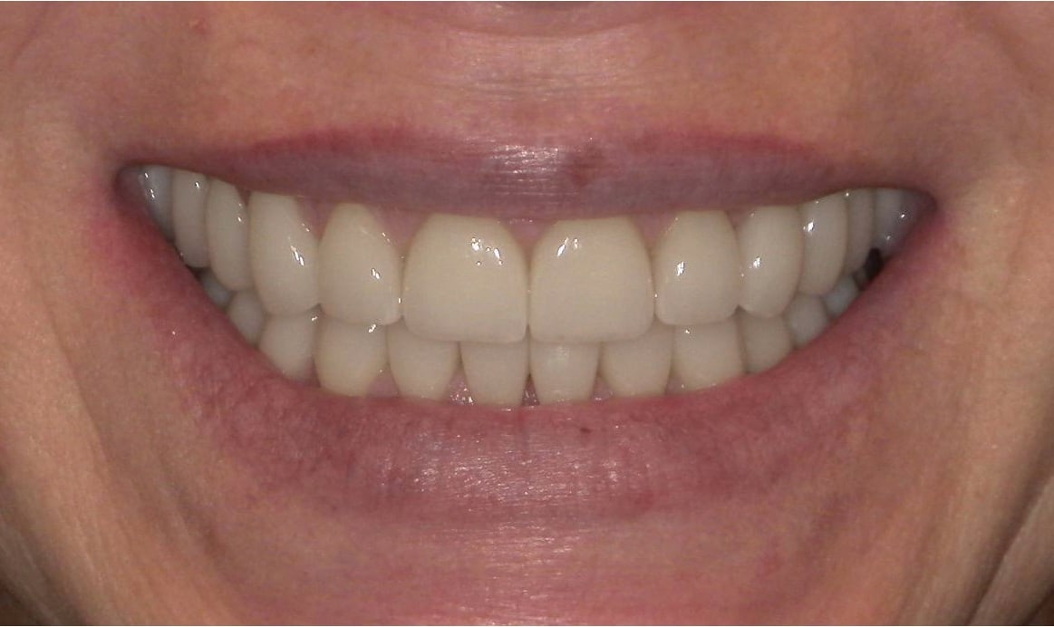 After treatment photo for Smile Gallery Case 19