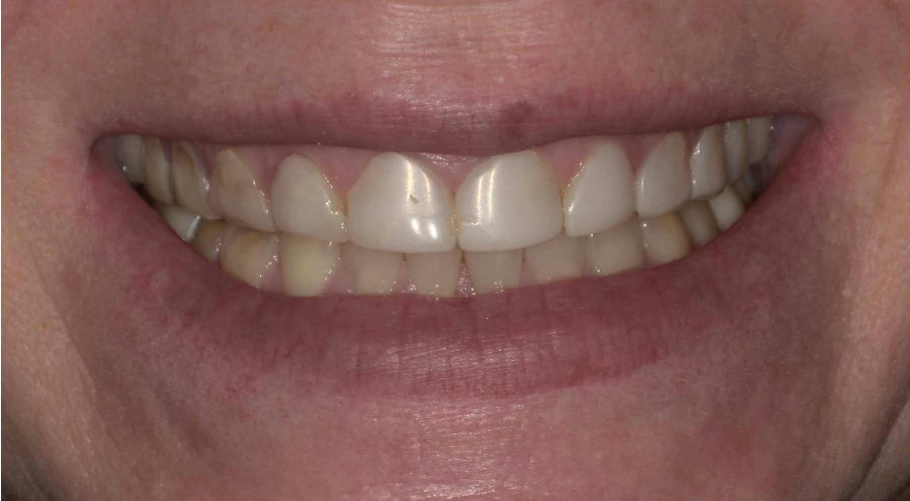 Before treatment photo for Smile Gallery Case 19