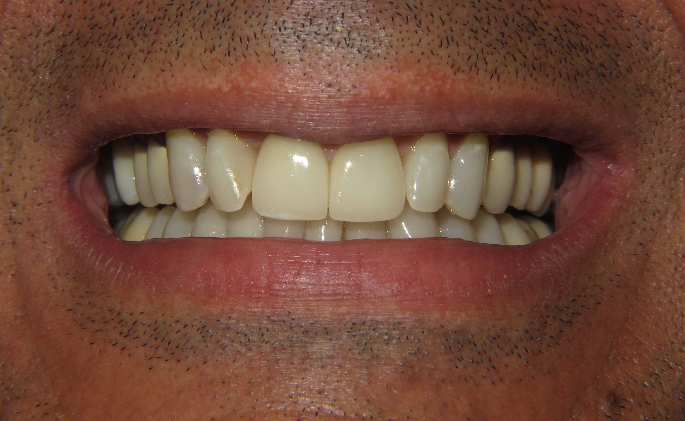After treatment photo for Smile Gallery Case 20