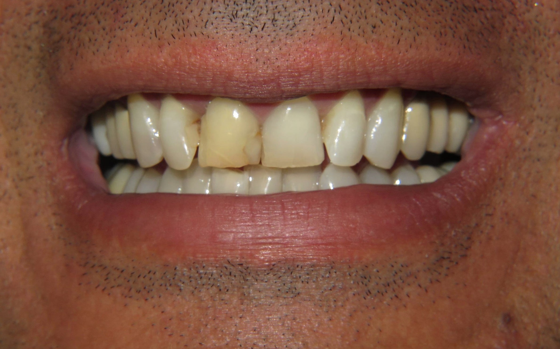 Before treatment photo for Smile Gallery Case 20