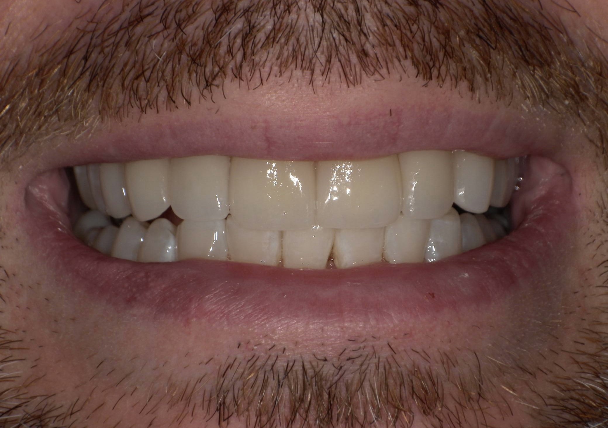 After treatment photo for Smile Gallery Case 21