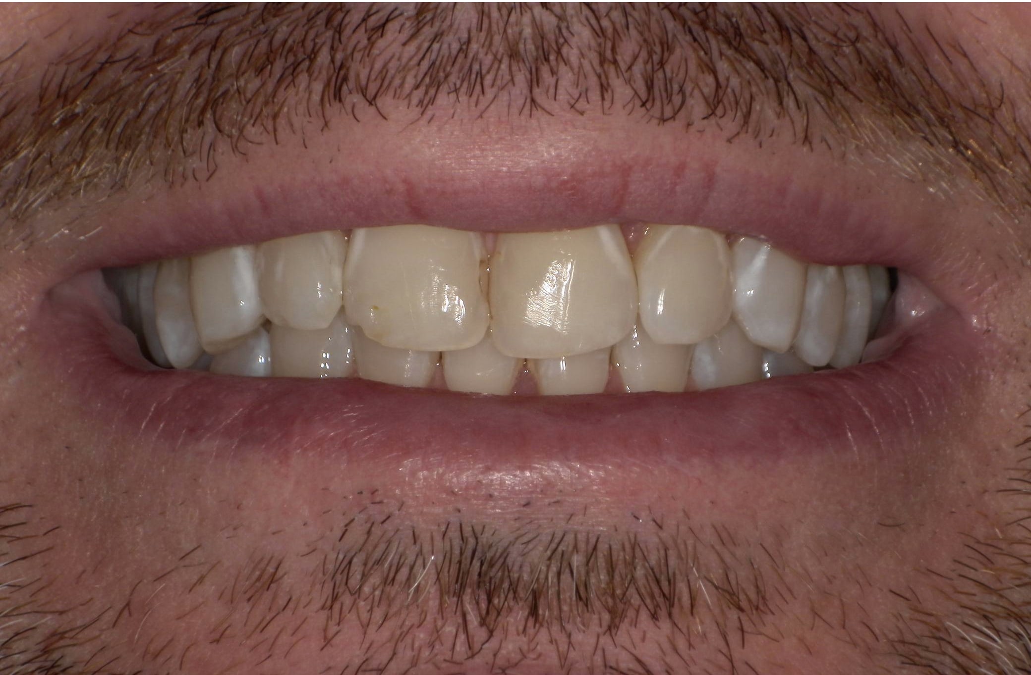 Before treatment photo for Smile Gallery Case 21