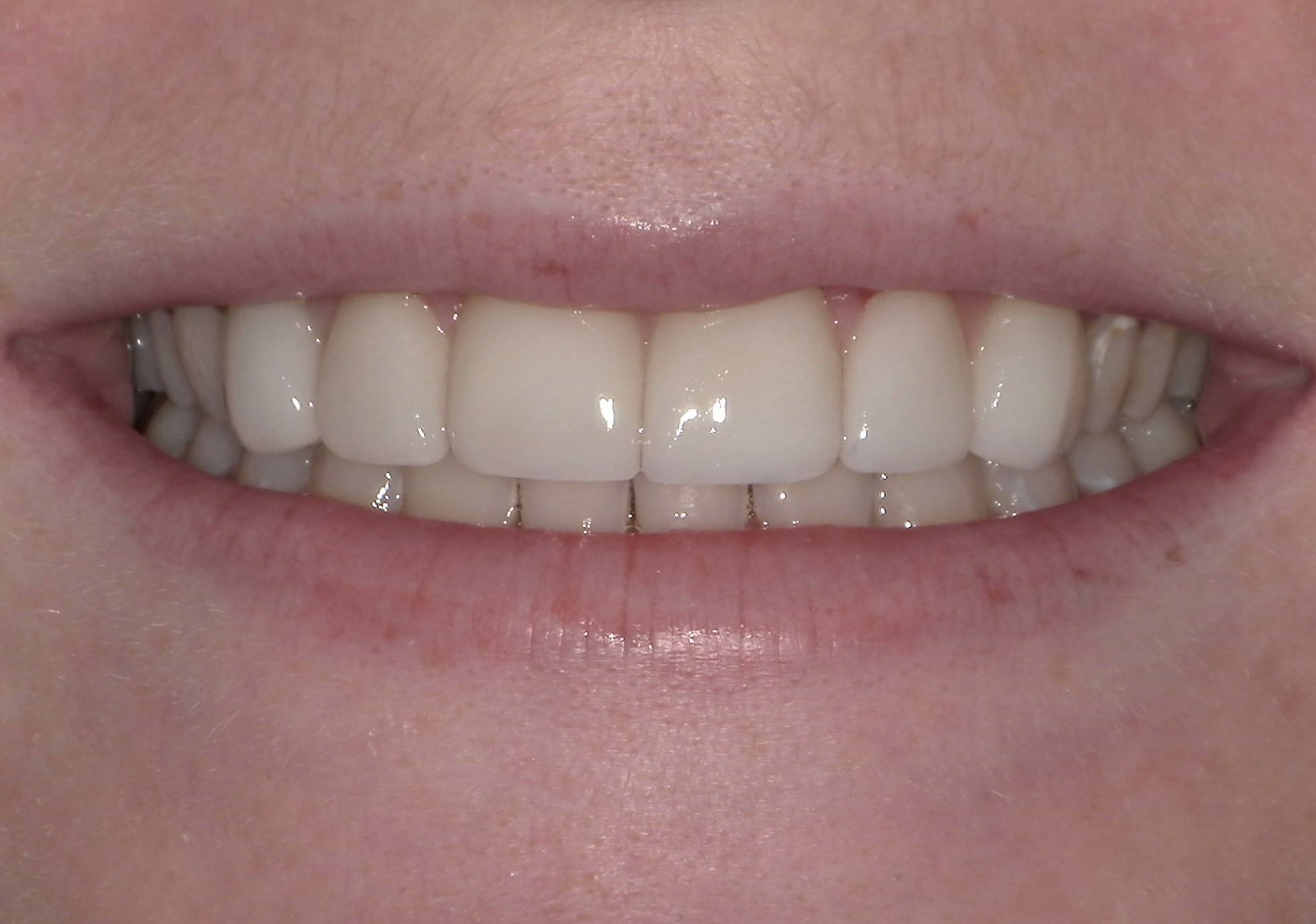 After treatment photo for Smile Gallery Case 22