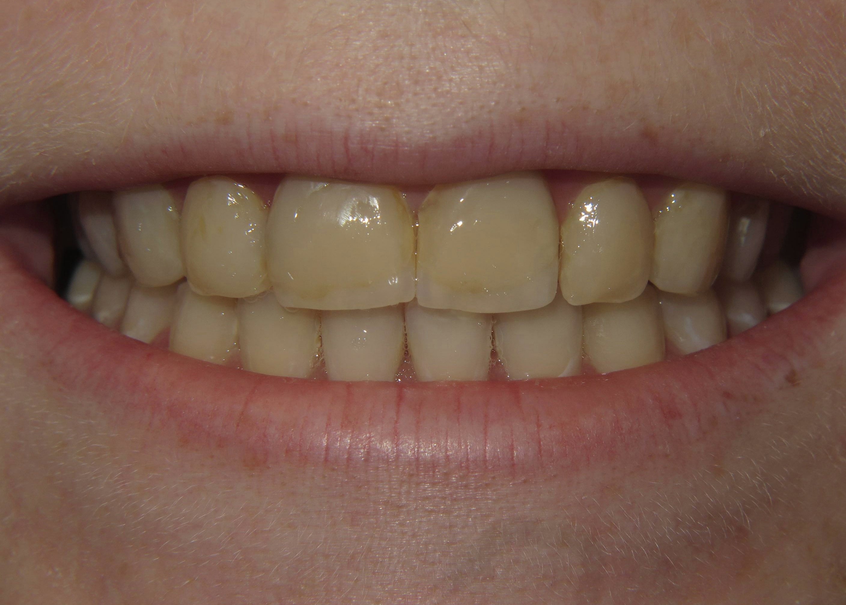 Before treatment photo for Smile Gallery Case 22