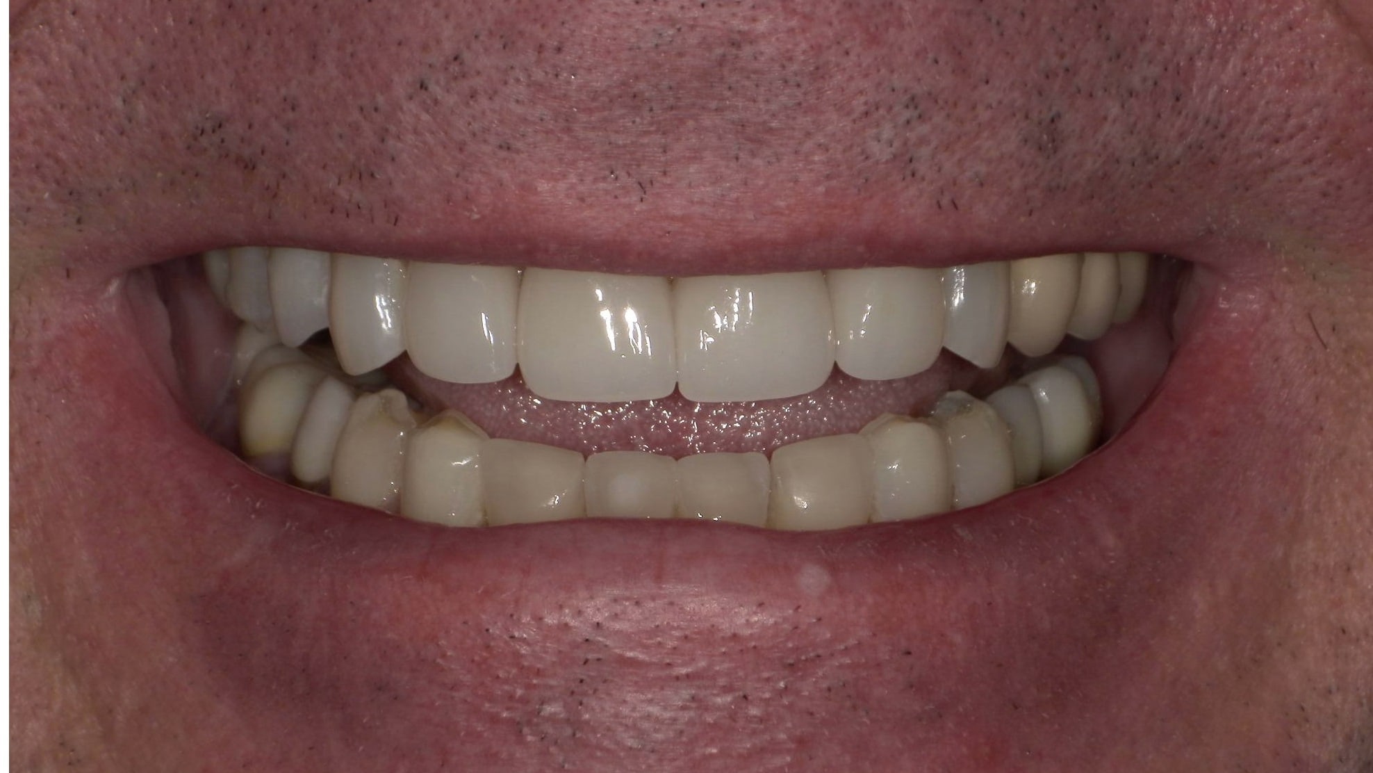 After treatment photo for Smile Gallery Case 23