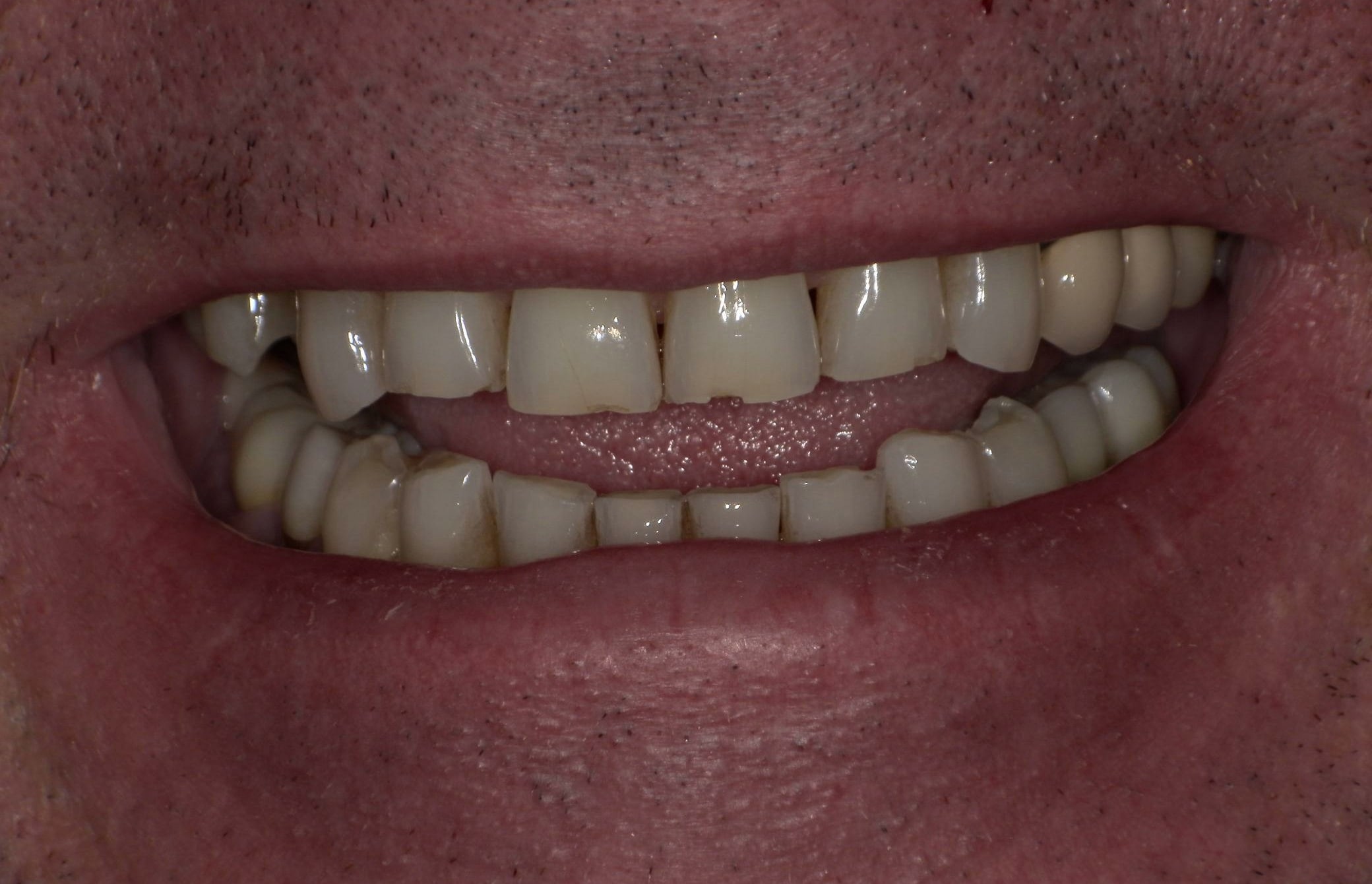 Before treatment photo for Smile Gallery Case 23