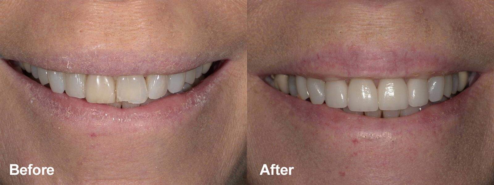 Smile Gallery Case 01: Invisalign and Select Veneers