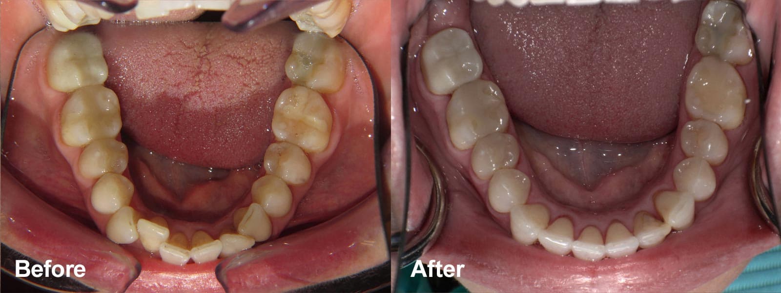 Smile Gallery Case 02: Invisalign and Whitening