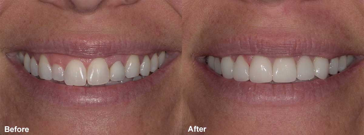 Smile Gallery Case 03: Veneers and Laser Gum Contouring