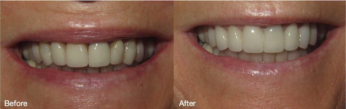 Smile Gallery Case 04: Porcelain Crowns