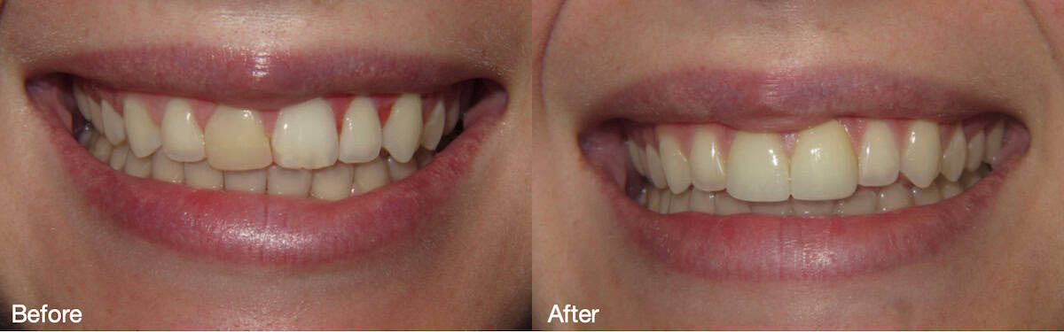 Smile Gallery Case 05: Select Veneers