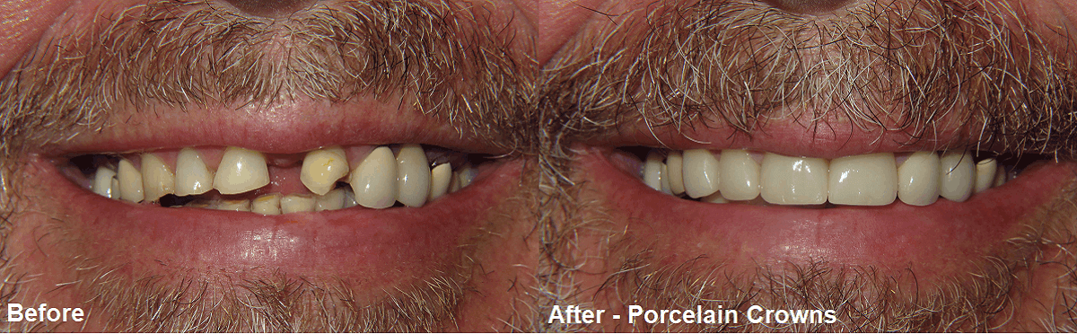 Smile Gallery Case 07: Porcelain Crowns