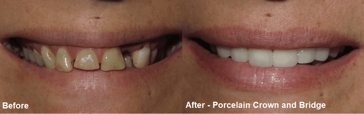 Smile Gallery Case 08: Porcelain Crown and Bridge