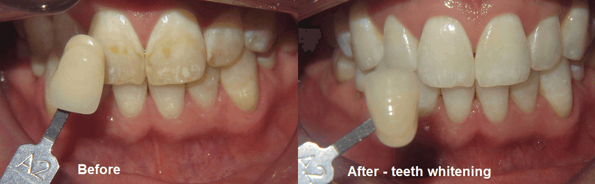 Smile Gallery Case 09: Teeth Whitening