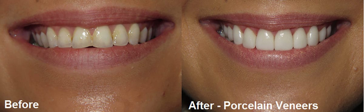 Smile Gallery Case 10: Porcelain Veneers