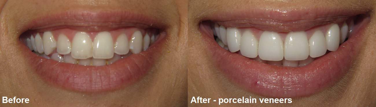 Smile Gallery Case 11: Porcelain Veneers