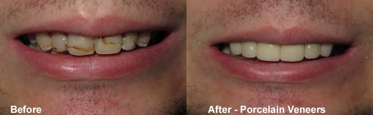 Smile Gallery Case 13: Little Porcelain Veneers