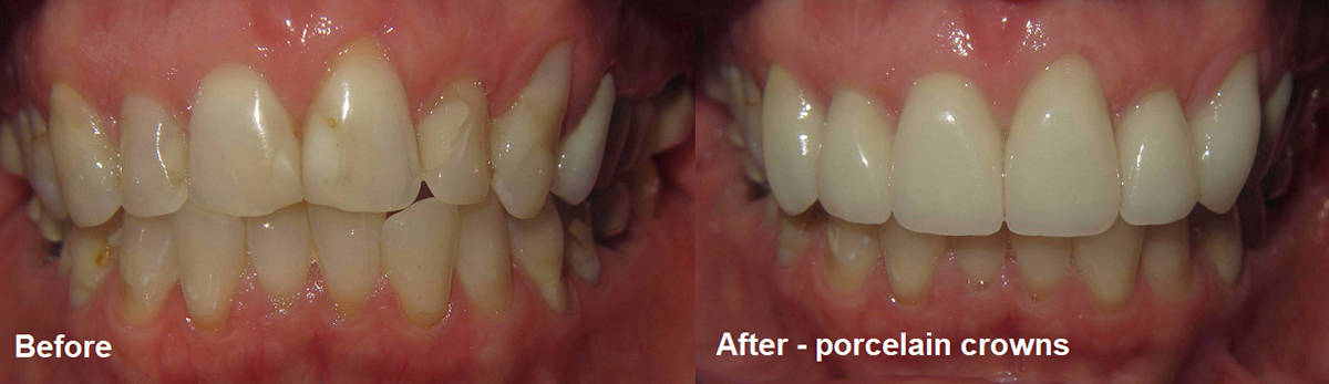 Smile Gallery Case 14: Porcelain Crowns