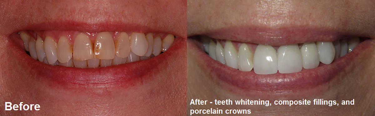 Smile Gallery Case 15: Teeth Whitening, Composite Fillings, and Porcelain Crowns