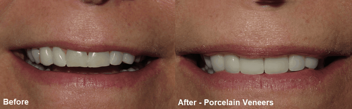 Smile Gallery Case 16: Porcelain Veneers