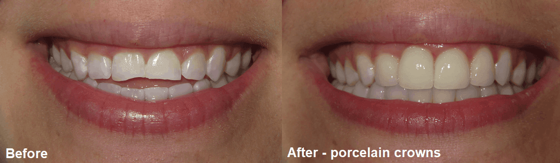 Smile Gallery Case 17: Porcelain Crowns