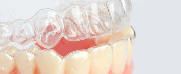 Invisalign