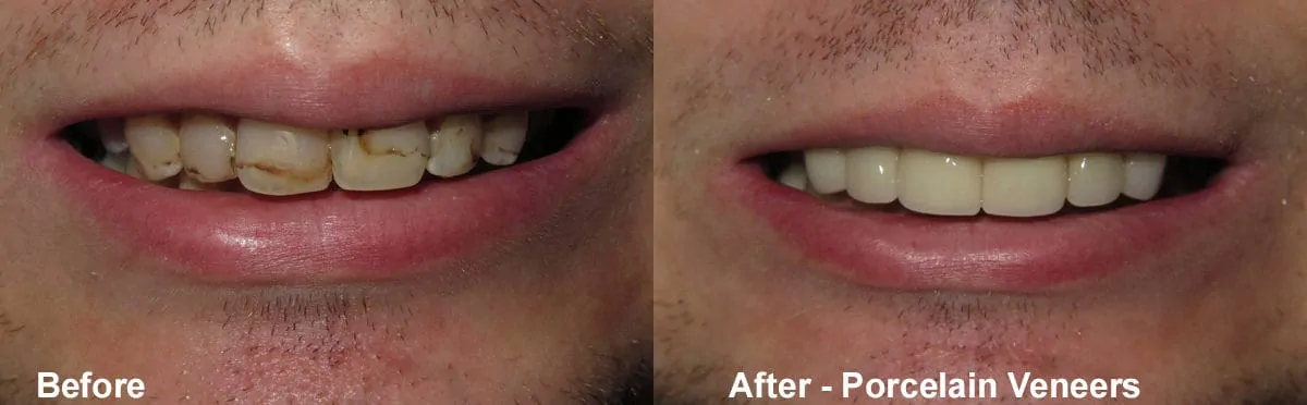 dental before and after - Broberg & Tieken Dental - Austin, TX