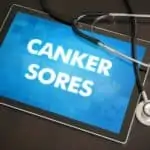canker sores